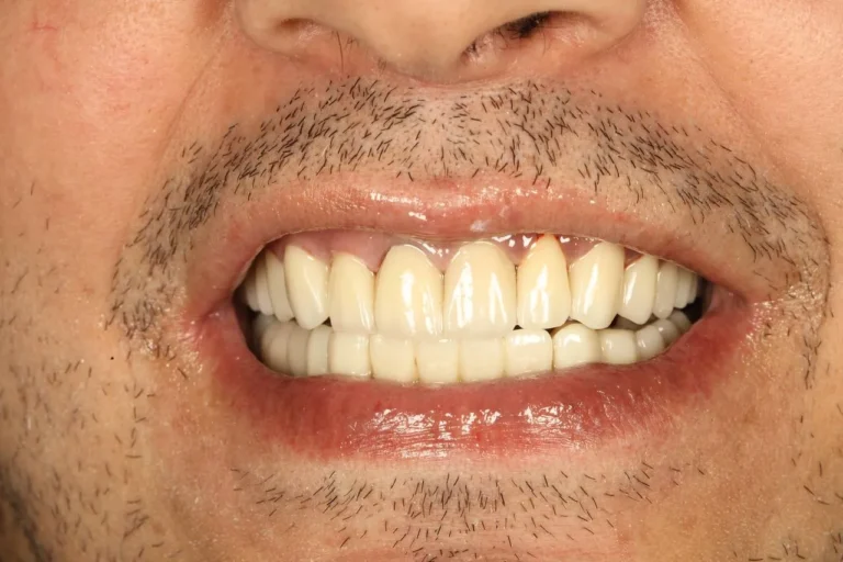 تحلیل لثه چیست؟ علائم، علت‌ها، روش‌های درمان و پیشگیری به زبان ساده