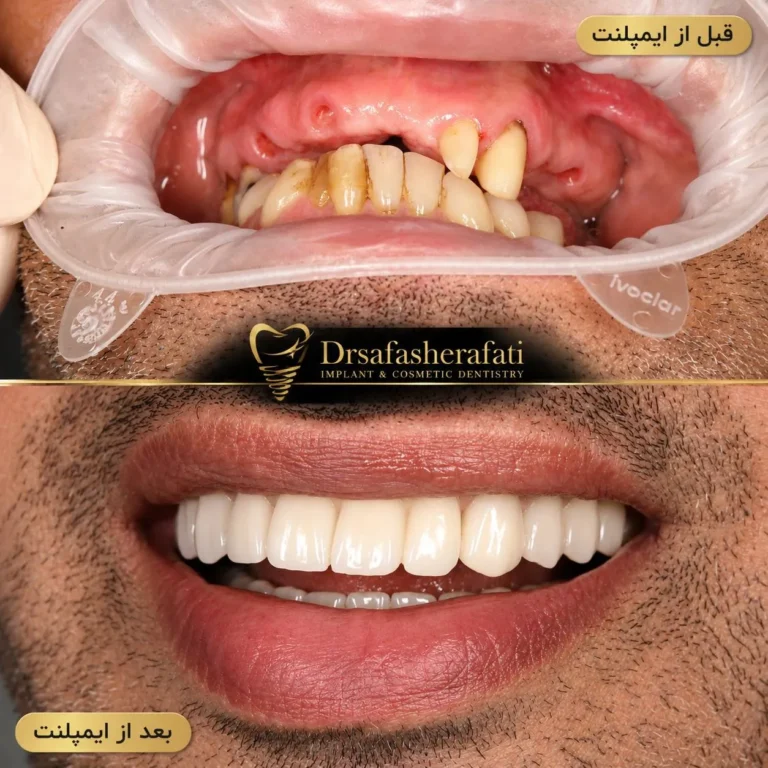 درد دندان ایمپلنت شده بعد از چند سال؛ علت‌ها، علائم خطر و درمان