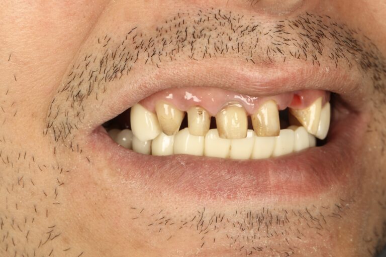 دندان چسبی بهتر است یا ایمپلنت؟